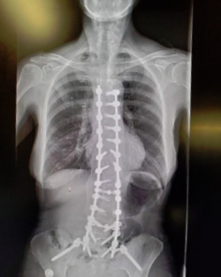 5 year after surgery